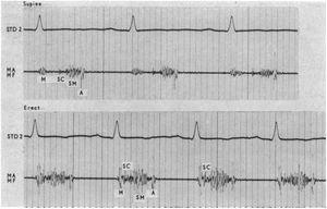 Phonocardiogram of a late systolic murmur and non-ejection click of a young woman, in the supine and erect positions, as was diagnosed at the time.