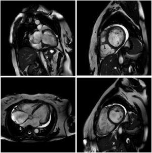 Cardiac magnetic resonance imaging showing congestive heart failure/cardiomyopathy of probable inflammatory etiology (Chagas myocarditis), with significant dysfunction and increased biventricular diameters, significantly dilated right atrium and tricuspid regurgitation, dilated left atrium and mitral insufficiency, and pericardial effusion.