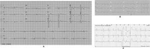 Electrocardiograms from patient II-2. A: ECG in sinus rhythm, ST-T segment abnormalities from V3 to V6. B: ECG, three years later, atrial fibrillation. C: 24-hour ECG monitoring strip from patient II-2, documenting atrial fibrillation and a ventricular triplet.