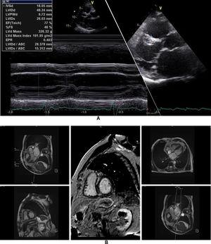 Echocardiogram and cardiac magnetic resonance imaging from patient II-2 (performed at the age of 84 years). A: Transthoracic echocardiogram, parasternal long axis view, 2-dimensional and M-mode, also showing asymmetric septal hypertrophy. B: These cardiac magnetic resonance images confirm the echocardiographic findings (asymmetric septal hypertrophy and mild mitral regurgitation) and provide tissue characterization data, with late gadolinium enhancement in the interventricular septum and in right ventricular insertion point in interventricular septum, typical findings of HCM.