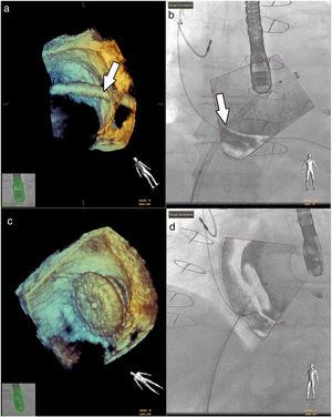 Fusion imaging for guidance of atrial septal defect closure. 3D TEE image (a) of the catheter crossing the atrial septal defect (white arrow) and overlaid image with fluoroscopy in (b). 3D TEE (c) and fusion imaging (d) shows the occluder device after deployment. TEE: transesophageal echocardiography. Image from Basman et al.4, reproduction allowed.