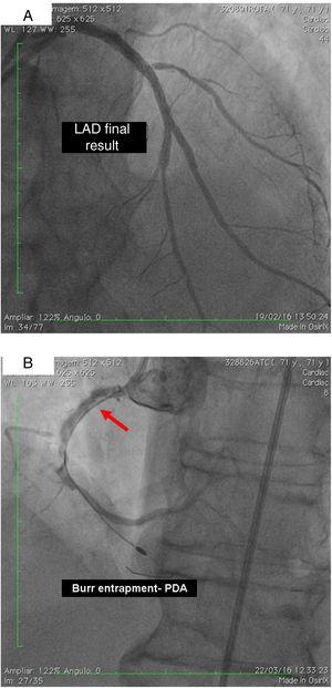 (A) Percutaneous coronary intervention of the left main and left anterior descending artery (LAD) with two overlapping drug-eluting stents (DES) and the second diagonal branch with another mini-crush DES after rotablation with 1.5 mm burr, and ultimate success (TIMI flow 3); (B) burr entrapment in the posterior descending artery (PDA). The stiffness of the system when pullback was attempted is evident (arrow).
