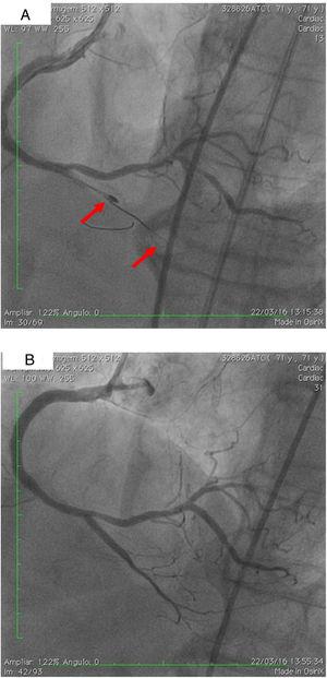 (A) Two parallel wires and the ‘knuckle’ at the distal lumen of the posterior descending artery (PDA) (arrow), with the 1.25 mm balloon tangential to the burr; (B) right coronary artery, PDA and right posterolateral artery, final result after implantation of three drug-eluting stents. Some improvement of collaterals to the left circumflex artery can be seen.