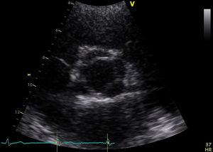 Echocardiogram before surgery showing the open quadricuspid aortic valve.
