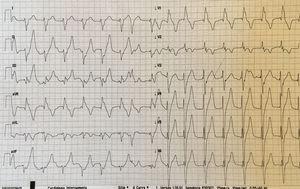Electrocardiogram showing a paced right bundle branch block pattern.