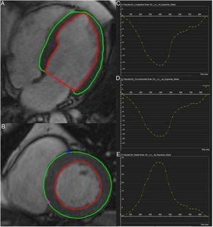 End-diastolic endocardial (red) and epicardial (green) contours of the left ventricle in a four-chamber image (A) and on a short-axis view (B) using tissue-tracking, and global left ventricular longitudinal (C), circumferential (D), and radial (E) strain curves.