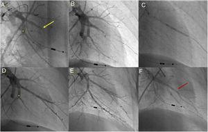 Balloon pulmonary angioplasty of segment A7 + 8 of the left lower lobe. (A) Selective pulmonary angiography demonstrating total occlusion of the A8 segment (yellow arrow) and a web at the bifurcation of segment 7 (*); (B) passage of a Whisper MS guidewire (Abbot Vascular, Santa Clara, CA, USA), through the occlusion in segment A8; (C) vessel dilation with a semicompliant 4.0/20 Pantera Pro balloon (Biotronik SE & Co KG, Berlin, Germany); (D) selective pulmonary angiography showing a good final result in segment A8 and segment A7 not yet treated (*); (E) following dilation of segment A7 at the level of the web (*), a good final angiographic result is achieved, with increased arterial flow; (F) venous return observed (red arrow) on final selective angiography of segment A7 + 8 documenting pulmonary flow grade 3.
