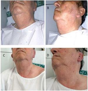 (A and B) Neck swelling predominantly on the right side secondary to acute enlargement of the right submandibular gland; (C and D) resolution of clinical picture of non-infectious right submandibular iodide-induced sialadenitis.