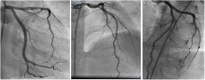 Control coronary angiography showed a normal coronary artery flow and no more thrombi in distal left anterior descending artery.