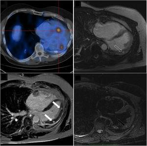 Right lower panel: Cardiac magnetic resonance imaging showing two rounded, well-defined intramyocardial high signal intensity lesions in T2-weighted sequences, at the medium and distal segments of the anterolateral wall (dark arrow). These two lesions showed isosignal intensity in T1-weighted images, and intense early (upper right panel, dashed arrow) and late (lower left panel, white arrows) gadolinium enhancement; Upper left panel: Positron emission tomography image shows increased 68Ga-DOTATOC uptake, further supporting the anatomic correspondence of these foci.
