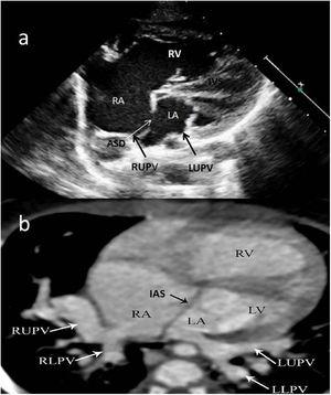 Two-year-old female patient with septum primum malposition and partial anomalous pulmonary venous return. (a) Modified 4-chamber view on echocardiographic examination; (b) computed tomography images in axial view. ASD: atrial septal defect; IAS; interatrial septum; IVS: interventricular septum; LA; left atrium; LLPV: left lower pulmonary vein; LUPV; left upper pulmonary vein; LV: left ventricle; RA; right atrium; RLPV: right lower pulmonary vein; RUPV: right upper pulmonary vein; RV: right ventricle.