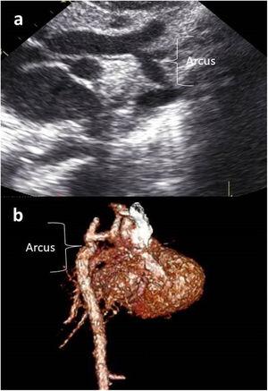 Thirty-day-old male patient with aortic arch hypoplasia. (a) Suprasternal view on echocardiographic examination. (b) Three-dimensional computed tomography images in right oblique volume-rendered view. Arcus: aortic arch.