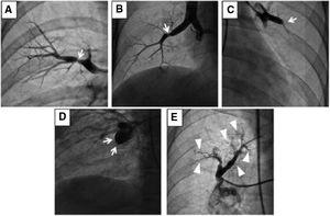 Angiographic classification of CTEPH lesions. (A) Type A: ring-like stenosis lesion. (B) Type B: web lesion. (C) Type C: subtotal lesion. (D) Type D: total occlusion lesion. (E) Type E: tortuous lesion. From A to E increases the complexity of BPA; decreasing the success rate and increasing the likelihood of complications. Reprinted with permission from Kawakami et al. Circ Cardiovasc Interv 2016;9:e003318.
