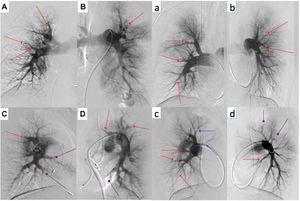 Digital subtraction angiography of two BPA patients (represented by upper and lowercase letters, respectively). We perform selective angiography of the right and left pulmonary arteries, acquiring images in anteroposterior (A and B; a and b) and profile (C and D; c and d) using a biplane angiography equipment. Different types of CTEPH lesions are indicated: web lesion (red arrows), ring-like stenosis (blue arrows) and occlusion-type lesion (purple arrows).