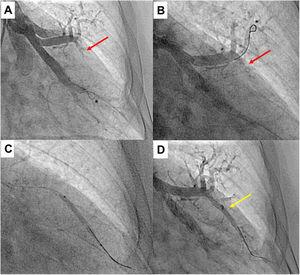 Upper segment of lingula BPA (left lung). A) Selective pulmonary angiography showing total occlusion of one vessel in lingula (red arrow); B) Selective angiography of lingula and passage of Gladius guide wire (Asahi Intecc Co., Aichi, Japan) through the vessel; C) Vessel dilation of the occluded lesion with a 3.0/30 mm semi-compliant balloon; D) Selective pulmonary angiography showing a good final result with increased arterial flow in the previous occluded vessel (yellow arrow); * shows the positioning of the distal wire with knuckle-wire technique which gives security of the procedure, decreasing the risk of perforation.