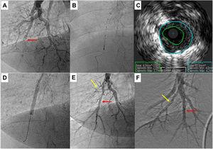Pulmonary balloon angioplasty of a total occluded vessel from a segment of inferior right lower lobe, guided by intravascular ultrasound (IVUS). A) Selective pulmonary angiography showing occlusion of one of the A10 subsegments (red arrow); B and C) IVUS using an Eagle Eye® Platinum ST catheter (Philips, Amsterdam, the Netherlands) enabling the accurate determination the real size of the vessel and, thus, size the balloons to be used during angioplasty; D) Dilatation of the vessel with a 4.0-mm diameter balloon; E) Selective pulmonary angiography showing a good final result of chronic total occlusion (CTO) balloon plastic angioplasty (BPA) (red arrow). There is another CTO in segment A9 (yellow arrow) that was proposed to intervene later; F) Two months later, the final angiography revealed good BPA result in the previous CTO intervention and A9 CTO lesion successfully treated.