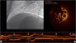 Optical coherence tomography. Intravascular imaging technique demonstrating the presence of fibrotic webs inside the vessel.