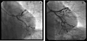 A critical lesion of the ostial and proximal anterior descending artery. B Angiography of the anterior descending artery after implantation of a 3.5×28mm stent.