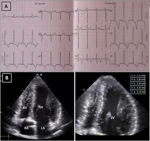Resting electrocardiogram (ECG) (top) and transthoracic echocardiogram (TTE) (bottom), before detraining. (A) ECG with voltage criteria for LV hypertrophy and marked deep T-wave inversion in leads I, II, III, aVF and V3-V6, with ST-segment depression; (B) TTE (apical 4-chamber view), showing moderate asymmetric hypertrophy, localized at the mid-apical segments of the left ventricle, with maximum wall thickness of 16 mm. LA: left atrium; LV: left ventricle; RA: right atrium; RV: right ventricle.