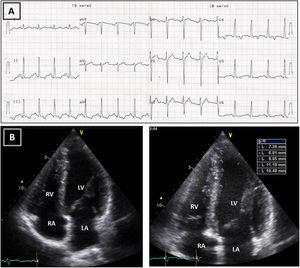Resting electrocardiogram (ECG) (top) and transthoracic echocardiogram (TTE) (bottom), performed four months after detraining. (A) The ECG shows a clear improvement of the T-wave abnormalities in the inferior and lateral leads, although the ECG is still abnormal; (B) on TTE, a decrease in both septal and apical LV wall thickness is evident (maximum 11 mm). LA: left atrium; LV: left ventricle; RA: right atrium; RV: right ventricle.