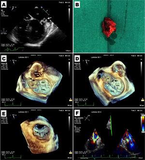 (A) Transesophageal echocardiography (TEE) of the mitral valve at 55°. Note the abscess at the anterolateral commissure of the mitral valve (arrow); (B) surgical specimen consisting of the mitral valve abscess; (C) TEE at 110° with three-dimensional (3D) reconstruction of the mitral valve (‘surgical’ view), showing perforation of the anterior leaflet at the A1 level and the abscess (asterisk); (D) TEE at 110° with 3D reconstruction of the mitral valve (‘surgical’ view), showing the other fistula directed toward the lateral wall of the left atrium and the abscess (asterisk); (E) TEE at 110° with 3D reconstruction of the mitral valve view from the ventricular side. Note the two fistulas in the same view; (F) TEE at 125° of the mitral valve with color Doppler showing the mitral regurgitation jets of both fistulas.