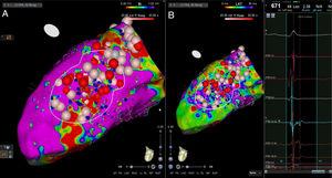 Radiofrequency applications in conduction channels and areas of late potentials visualized in high-density electroanatomic bipolar voltage mapping (A) and map of late potentials (B) in a non-ischemic cardiomyopathy patient.