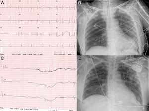 (A) Electrocardiogram showing sinus bradycardia and (B) sinus arrest with a pause >6 seconds. (C and D) Chest x-ray showing bilateral pulmonary infiltrates predominantly peripheral, before and after pacemaker implantation.