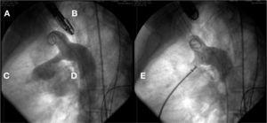 In A, aortography in the left view. The tubular ductus arteriosus, measuring 10mm, can be seen. In B, occlusion with CeraTM prosthesis for muscular VSD is observed.
