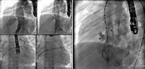 In A, left ventriculography in a long-axis left anterior oblique view shows VSD below the aortic valve. In B, VSD was occluded by a type-I VSD CeraTM Occluder. In C, the presence of a CeraTM ASD Flex Occluder device can be seen occluding the ostium secundum atrial septal defect and the device in the ventricular septal defect embolized into the left pulmonary artery branch. Note that the connecting pin is captured by the loop catheter. In D, the VSD prosthesis is being removed through the long sheath. In E, ASD device in position and the second VSD prosthesis completely closing the defect can be seen.