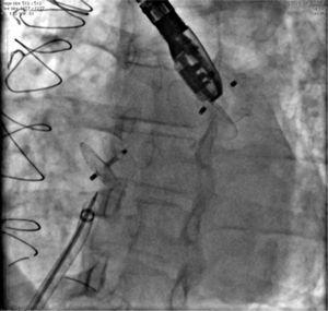 The picture shows the presence of the AmplatzerTM Cardiac Plug into the left atrial appendage, in the uppermost position; and, more inferiorly, the AmplatzerTM PFO Occluder device occluding the foramen ovale. The long sheath with double curvature and the delivery cable inwardly can also be seen, immediately after the release of the second prosthesis.