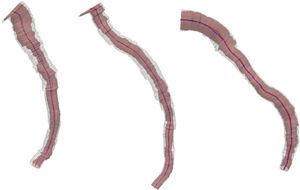 From left to right, three-dimensional reconstruction of left anterior descending artery (cases 1 and 2) and left circumflex artery (case 3). The lumen and the external elastic membrane are represented by red and blue center lines, and by pink and white volumetric filling, respectively.