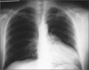Chest X-ray: counterclockwise heart axis deviation.