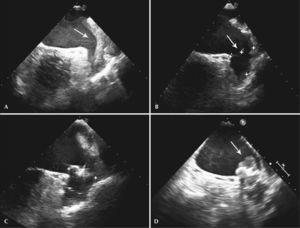 Left Atrial Appendage Closure With The Watchman™ Device | Revista ...