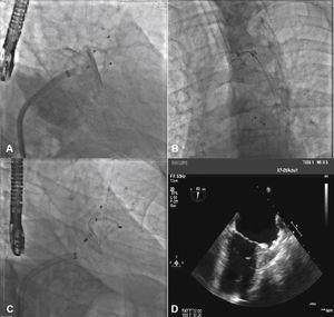 Percutaneous Occlusion Of The Left Atrial Appendage With AMPLATZER ...