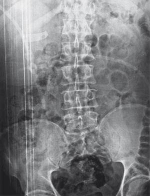 Radiografía simple de abdomen.