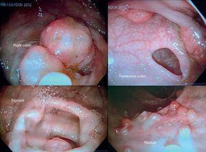 Colonoscopy with more than 50 polyps scattered throughout the colon and rectum.