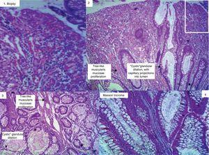 Histological study: biopsy of polyp with hyperplastic aspect (1). Hamartomatous polyp (2 and 3). The white square represents the hyperplastic component in a hamartomatous polyp. Masson trichrome staining showing muscle fiber bundle (4).
