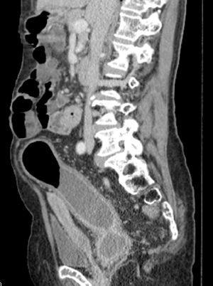 Enterography by computed tomography of abdomen (coronal section) showing wall thickening, luminal narrowing, “comb” signal and contrast hyper-uptake.