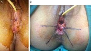 (A) Placing the urinary catheter; (B) identifying the skin-flap.