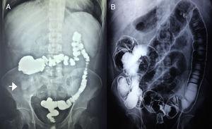Barium enema before (A) and after (B) intestinal transit reconstruction (ITR). Arrow, ostomy.