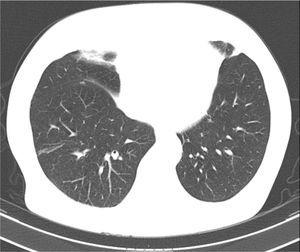 Lung metastases.