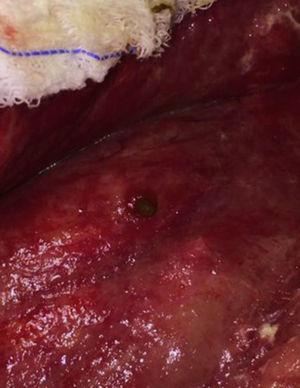 Appendicular fistula orifice in granulation tissue.
