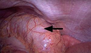 Voluminous cecal appendix revealed by laparoscopy (arrow).