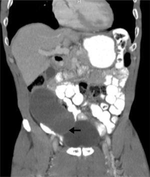 Lesion in topography of cecal appendix, hypodense, in a sagittal CT of abdomen (arrow).