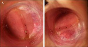 (A, B) Anoscopy: partially expelled staples at the level of the stapled line without any sign of inflammation.