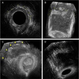 360° tridimensional transanal ultrasound: yellow arrows indicate the staple line. (A) 2D visualization; (B, C) 3D visualization with rendering; (D) 3D visualization.