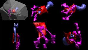Three-dimensional final image showing fistulous paths (purple), rectum (blue) and levator ani muscles (red).