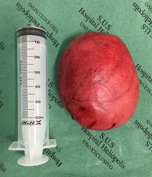 Surgical specimen after tumor resection.
