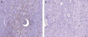Immunohistochemical analysis showing mesenchymal neoplasm with fibrillar pattern positive for smooth muscle actin (A) and negative for desmin (B).