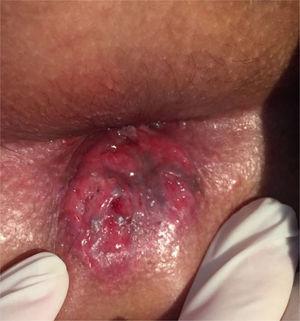 Ulceration in the anal margin.